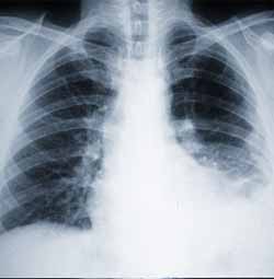 Mesothelioma Treatment Asbestos Cancer Symptoms Tests Research